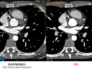 필립스, 국제CT 심포지움서 새로운 IMR 기술 발표