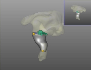 딜라이트 보청기, 3D 프린터로 맞춤형 보청기 제작