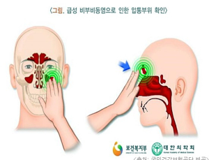 [건강톡톡] 어릴 적 축농증 수술은 발육에 악영향 우려