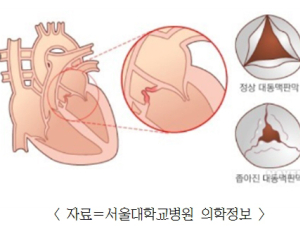 50대 이상 환자 많은 ‘대동맥판협착’ 어떤 질환?