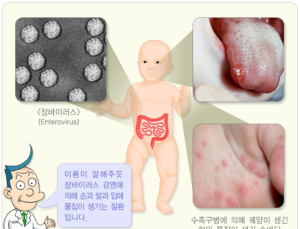 봄철 ‘수족구병’ 발생 증가…보건당국 손씻기 등 예방 강화 당부