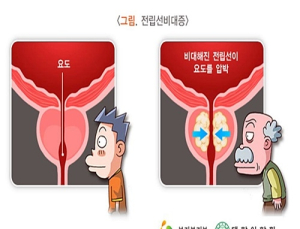 ‘전립선 비대증’ 20대 남성 증가세 심상치 않다