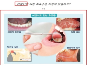 '이갈이’, ‘코골이’ 방지 등 의학적 효능 오인 광고 의료기기 판매 사이트 적발