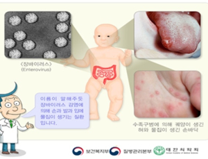 0~6세 수족구병 발생 증가…8월 말까지 환자 지속될 듯