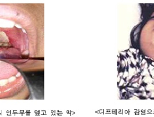 후진국감염병 '디프테리아' 환자 전세계서 증가…베트남서 68명 발생