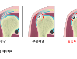 [정동리포트]  어깨 회전근개 파열 조기 치료, 오십견 오진 지뢰 제거해야 