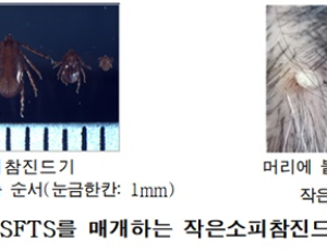 경북대병원 의료진 5명, 응급환자 심폐소생술 후 SFTS 감염…