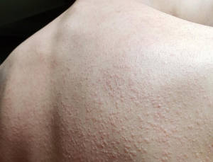 운동하면 붉게 올라오는 두드러기...1020남성 노린다