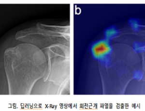 어깨 엑스레이만으로 회전근개 파열 가능성 예측한다