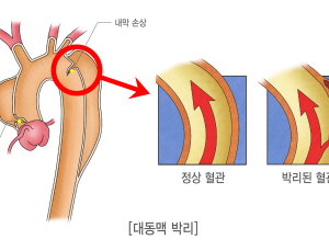 '초응급' 대동맥 박리, 20년 새 수술 성공률 98%