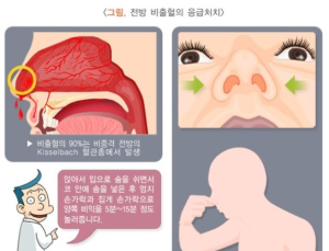 건조한 봄철 '코피' 주의…'10~15분 이상' 나오면 내원해야