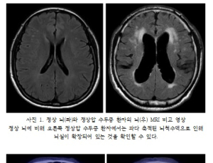 노인 100명 중 2명은 '정상압 수두증'…'파킨슨병' 동반되기도