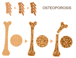골다공증성 골절, ‘체중’보단 ‘체성분’이 더 중요