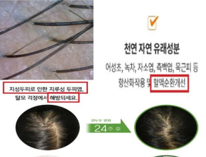 ‘모발 성장’ ‘탈모 예방’ 허위광고 대거 적발