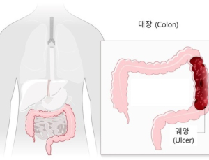 궤양성대장염, 10년새 4.8배 급증…이유는