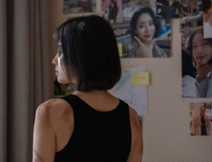 더 글로리 ‘고데기 화상’, 제대로 된 응급처치 하려면 