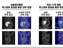 신생아 장천공, AI로 조기 발견…아산병원, 판독 모델 개발