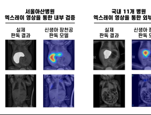 신생아 장천공, AI로 조기 발견…아산병원, 판독 모델 개발